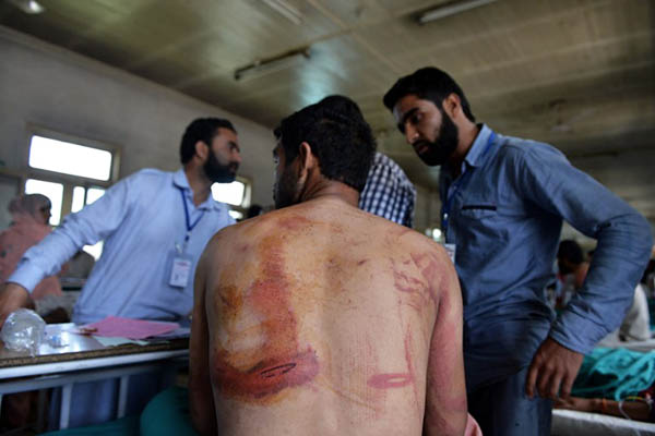 A Kashmiri allegedly beaten up by Indian army soldiers receives treatment at hospital. Tauseef Mustafa—AFP